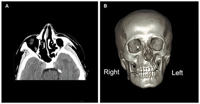 A Case Report of Parry–Romberg Syndrome Misdiagnosed as Multiple Sclerosis